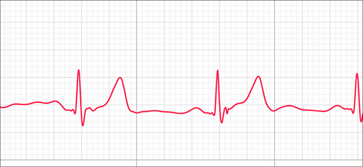 Vista previa de ECG que muestra el ritmo sinusal